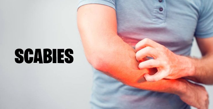 1 Scabies