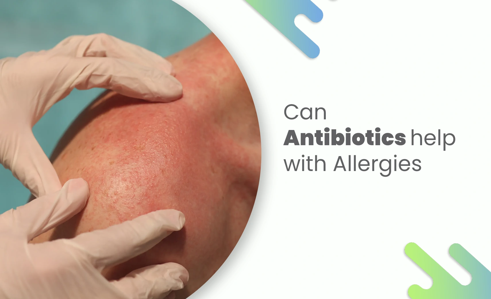 Doctor examining allergic skin reaction – Can Antibiotics Help with Allergies.