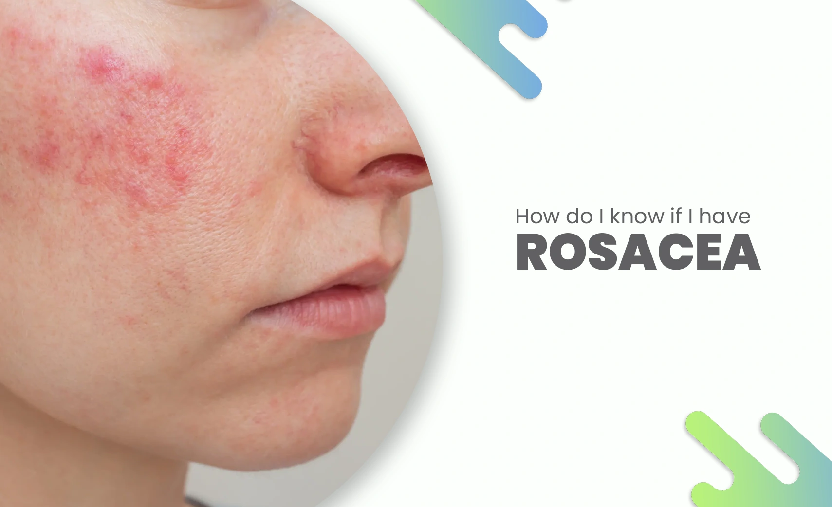 Close-up of cheek redness showing symptoms of rosacea.