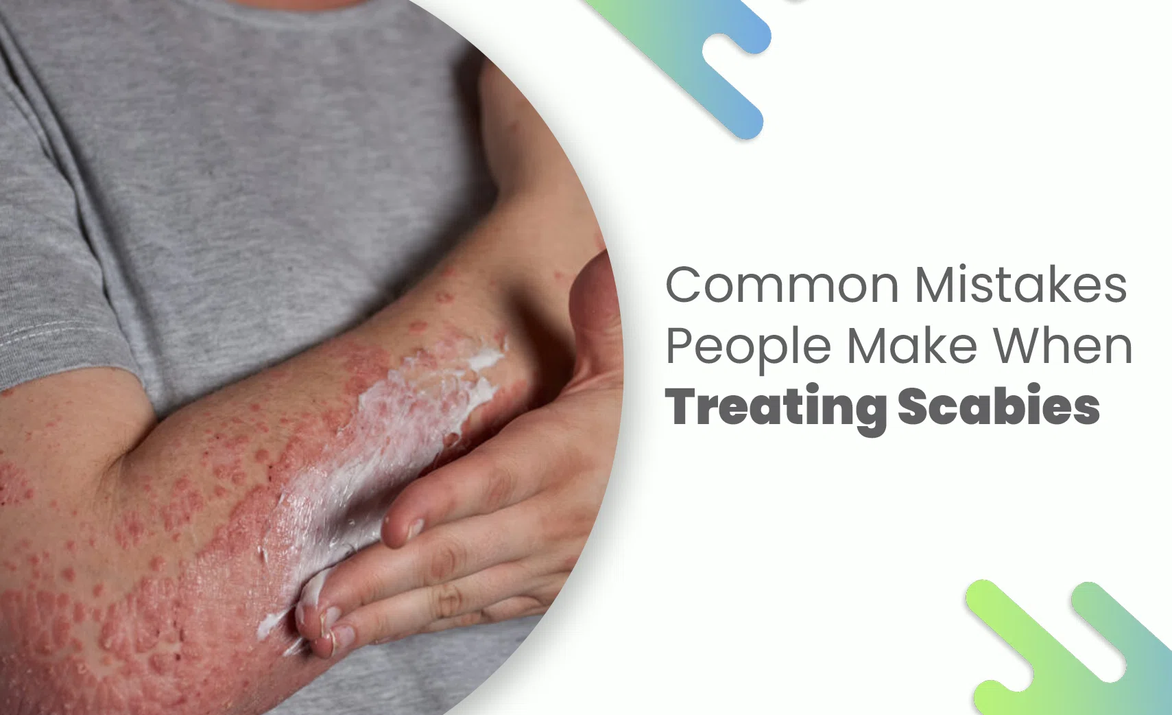 Applying cream on scabies rash on arm.