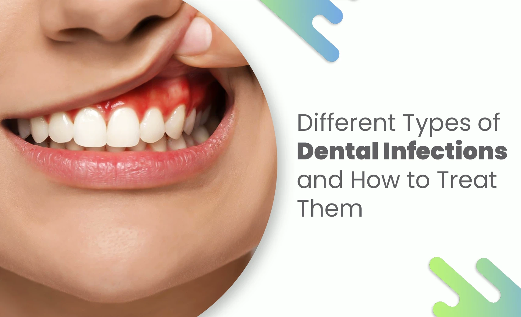 Gum redness caused by a dental infection