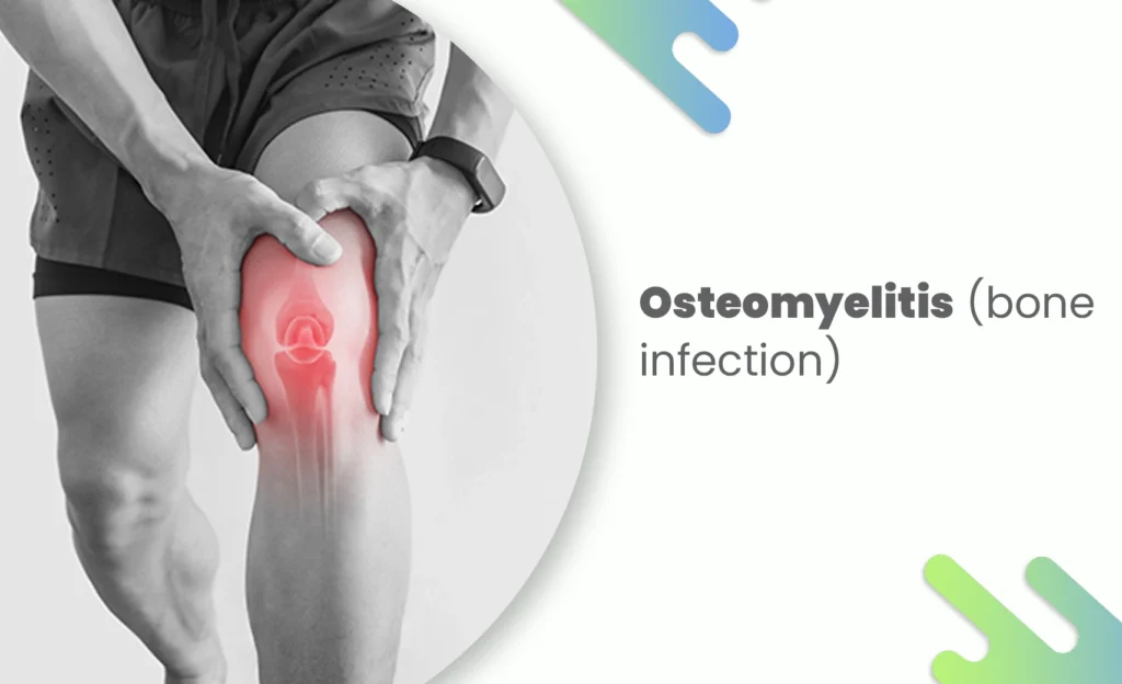 Osteomyelitis bone infection and bone problem in knee