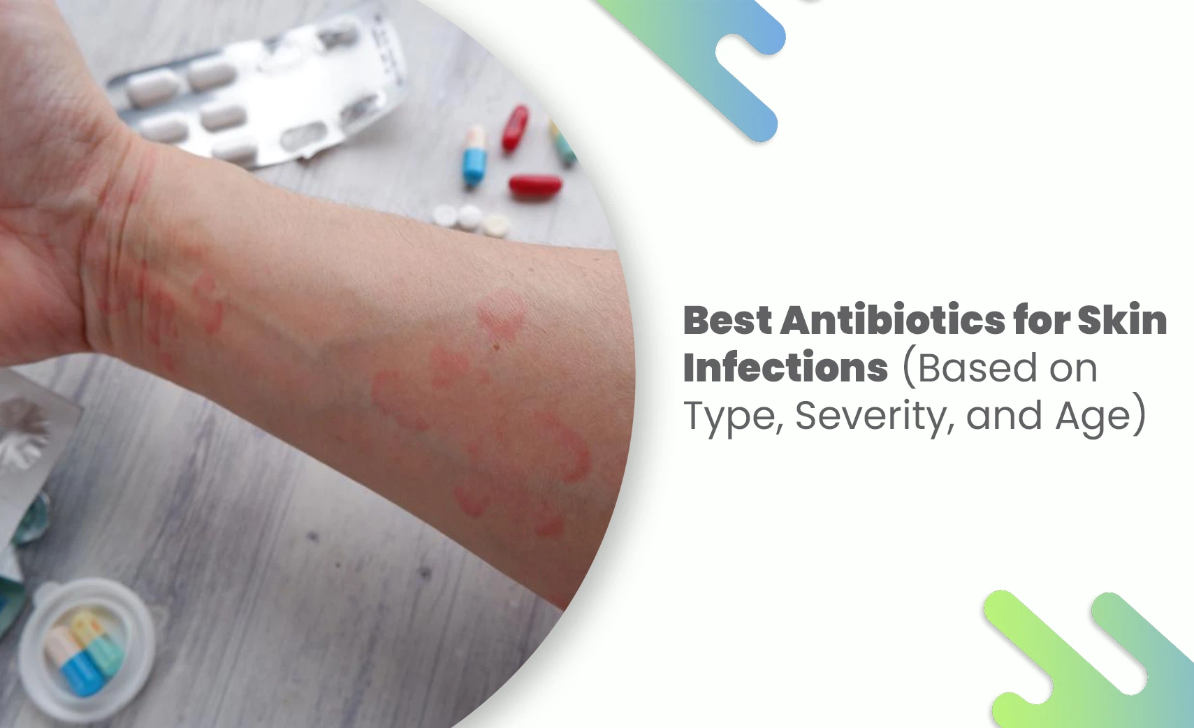 Best antibiotics for skin infections shown with rash on arm and medicines on table