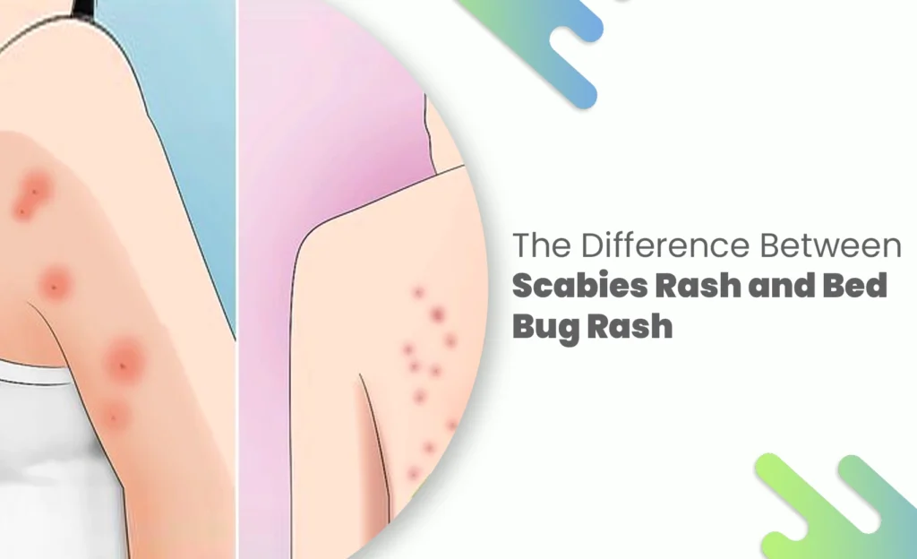 Comparison of scabies rash and bed bug rash shown on skin for identification