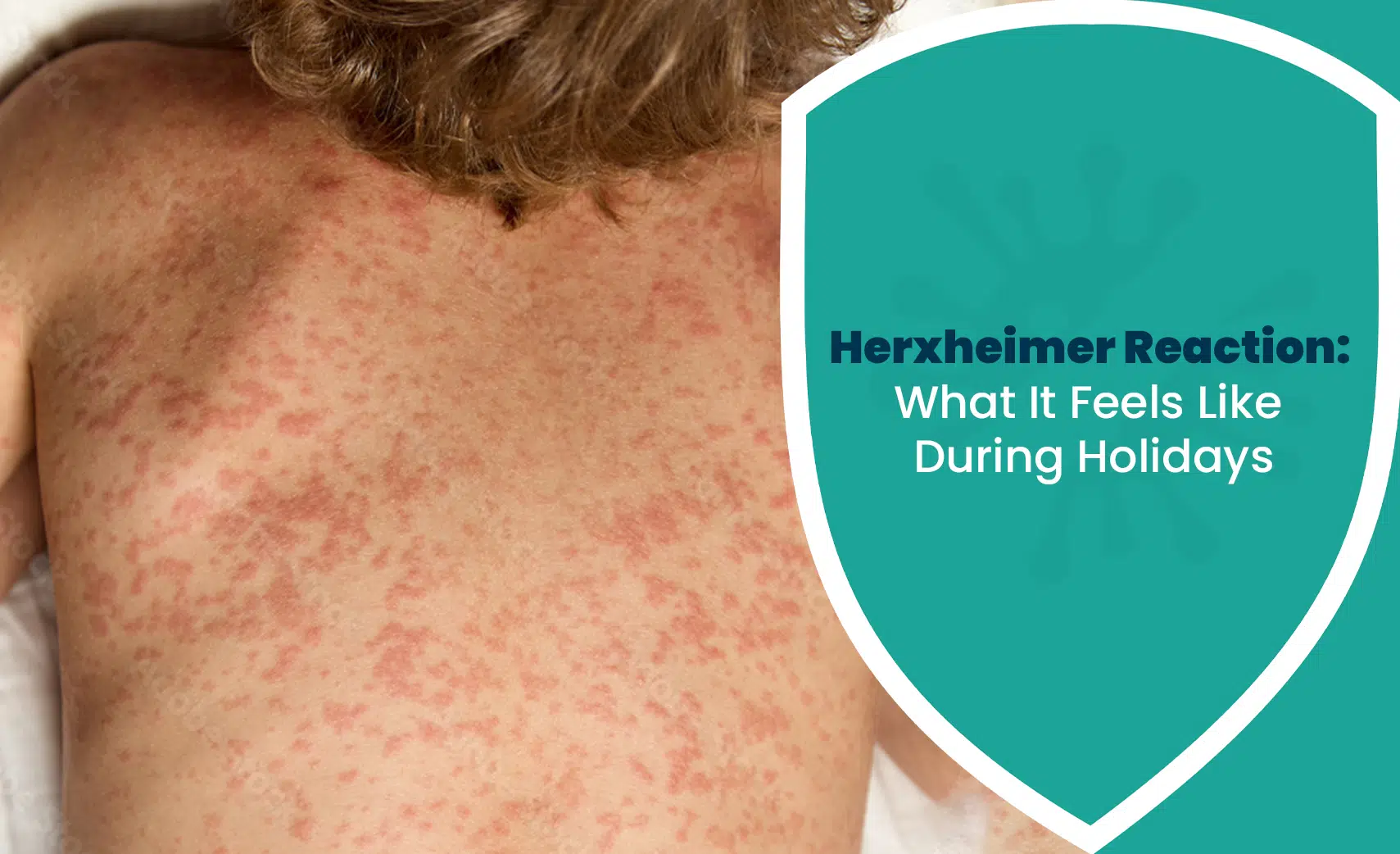 Herxheimer Reaction skin rash showing red blotchy inflammation during treatment