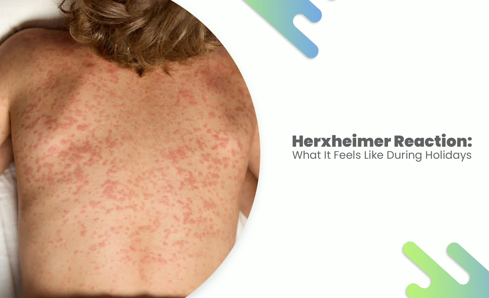 Herxheimer Reaction skin rash showing red blotchy inflammation during treatment