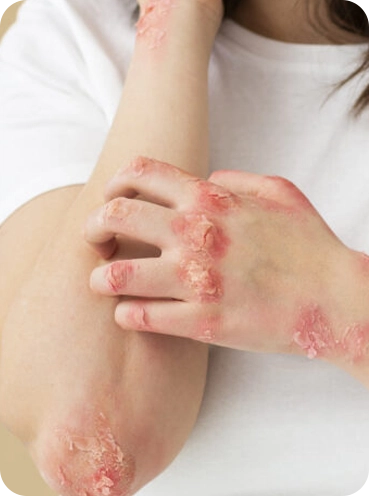 “Close-up of a person scratching inflamed, red, scaly skin on their forearms and hands, showing visible irritation and rash against a neutral background.