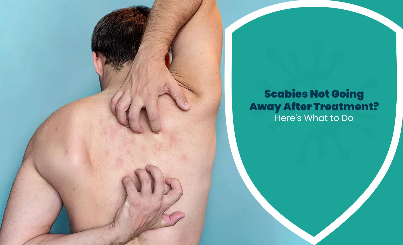 Man scratching irritated skin rash caused by scabies after treatment on back and shoulder