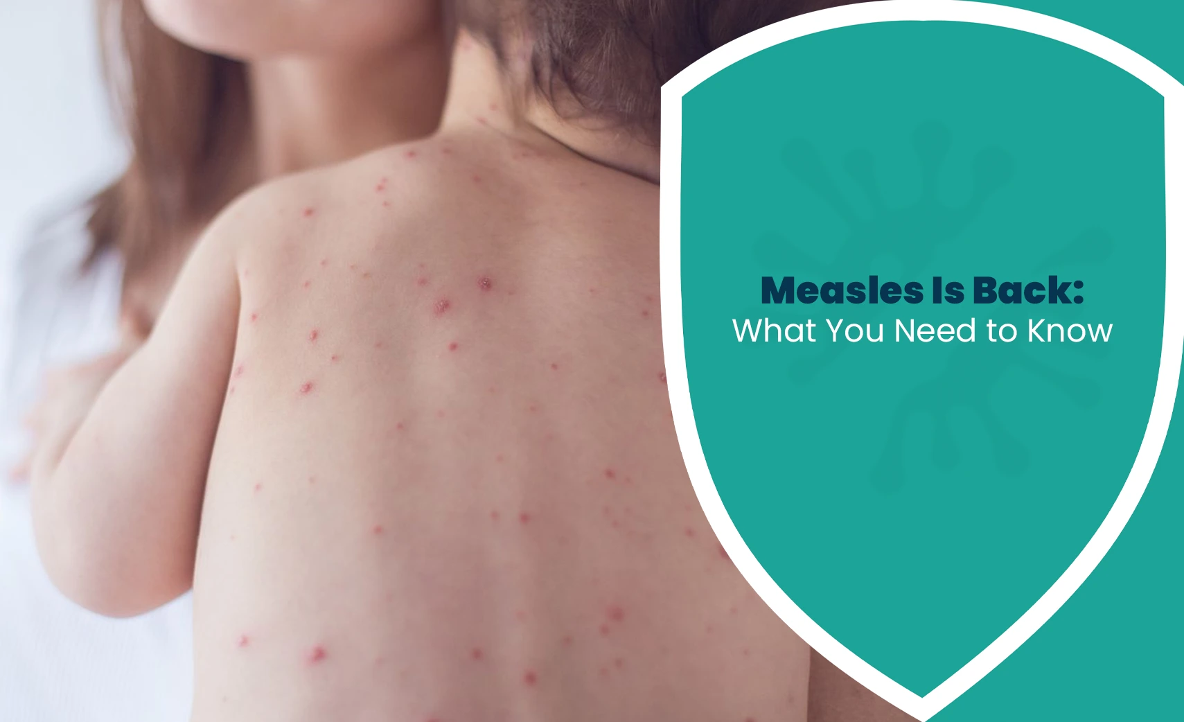 Measles rash on a child with an overview of measles symptoms