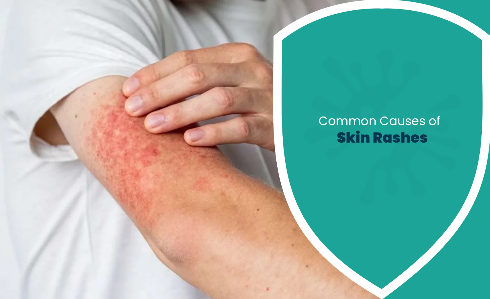 Common causes of skin rashes shown on an irritated and red arm