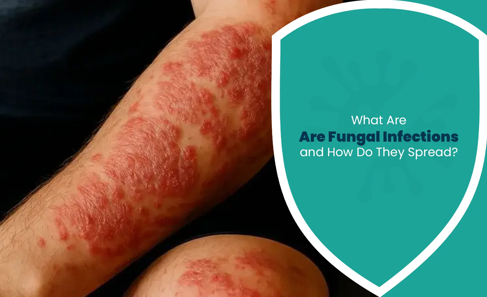 Fungal infections causing red, irritated skin patches on the arm