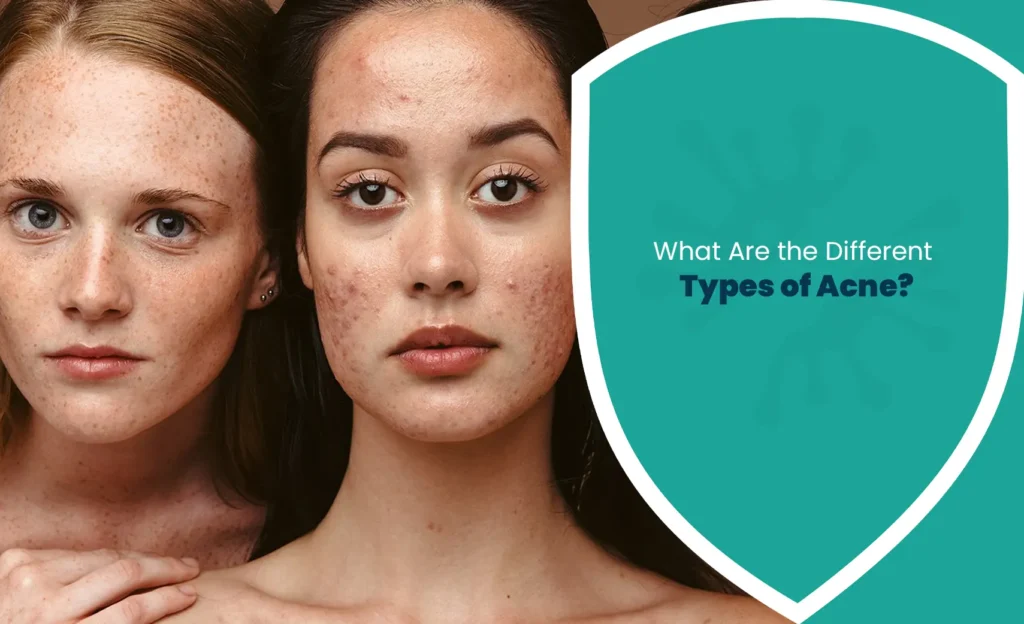 Different types of acne showing various acne symptoms and skin conditions