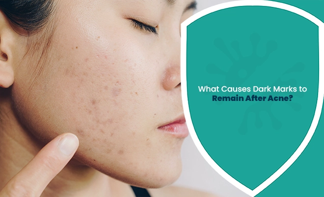 What Causes Dark Marks after acne with visible facial pigmentation