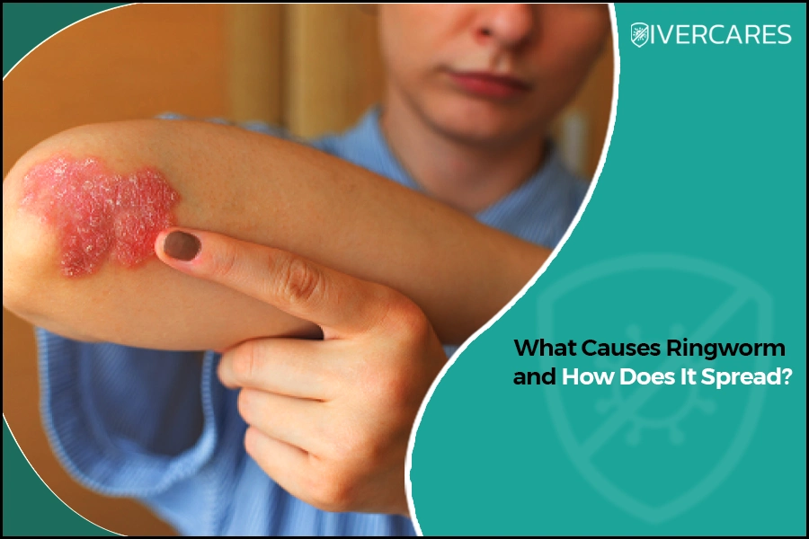 A person pointing to a red, inflamed skin patch showing visible signs of ringworm.