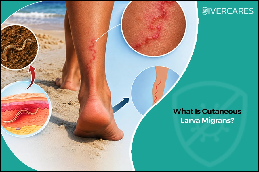 Cutaneous Larva Migrans showing a winding skin rash on the leg after exposure to contaminated beach sand.