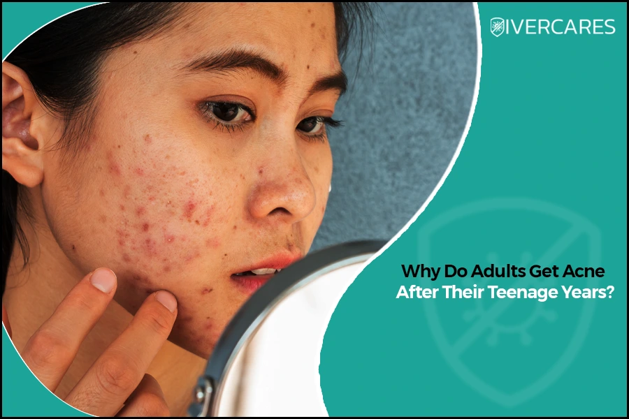 Adult acne showing inflamed pimples, redness, and acne marks on a woman's cheek.